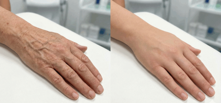 Rajeunissement du dos des mains